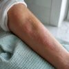 Avant-bras avec des plaques d’eczéma sèches
