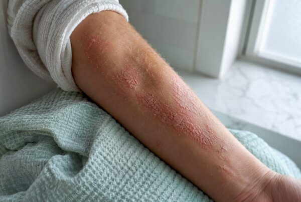 Avant-bras avec des plaques d’eczéma sèches