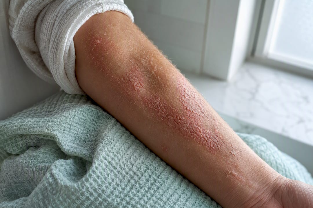 Avant-bras avec des plaques d’eczéma sèches